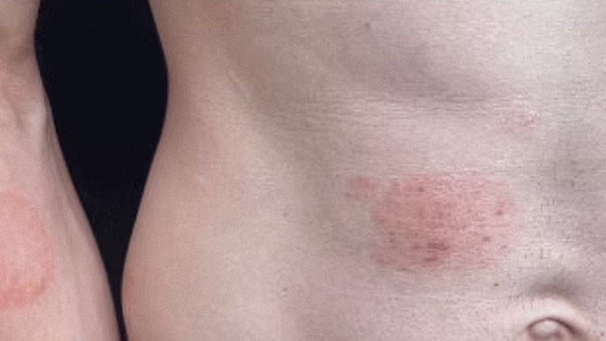 'Deri yiyen mantar' yanı başımıza geldi: Doktorlar alarmda