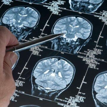 Alzheimer riskini artıran yeni genetik varyant tespit edildi