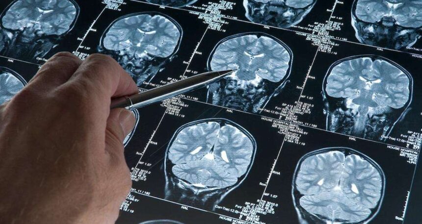 Alzheimer riskini artıran yeni genetik varyant tespit edildi