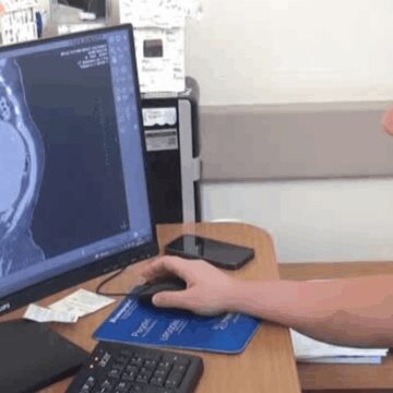 Karın ağrısı şikayeti bulunan hastanın böbreğinden çıkan şok etti