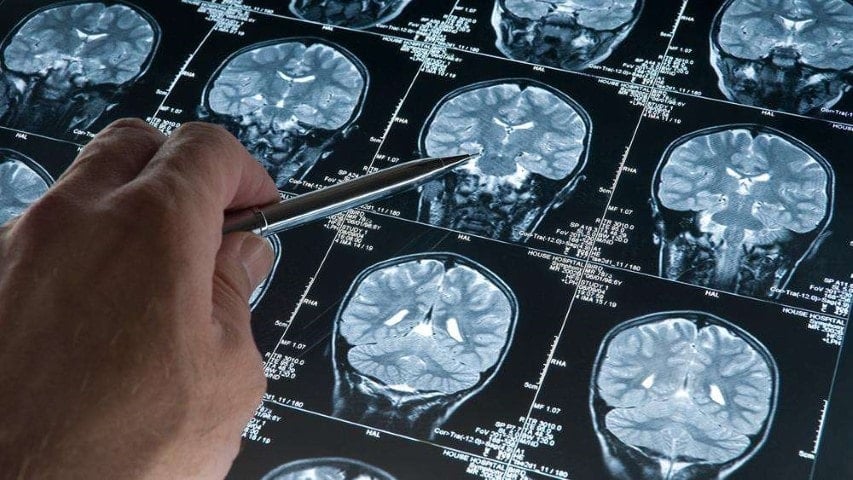 Tek tüp kanla Alzheimer teşhisi: Erken tanı artık mümkün