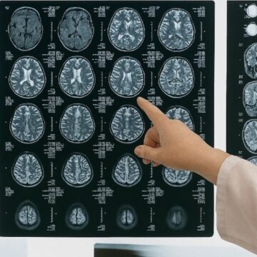 Çığır açan test bulundu! Yaşlılık hastalığını orta yaşta tespit ediyor