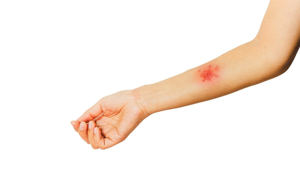 Gizli pandemi: Lyme