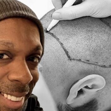 İstanbul’da yaptırdığı saç ekimi sonu oldu!