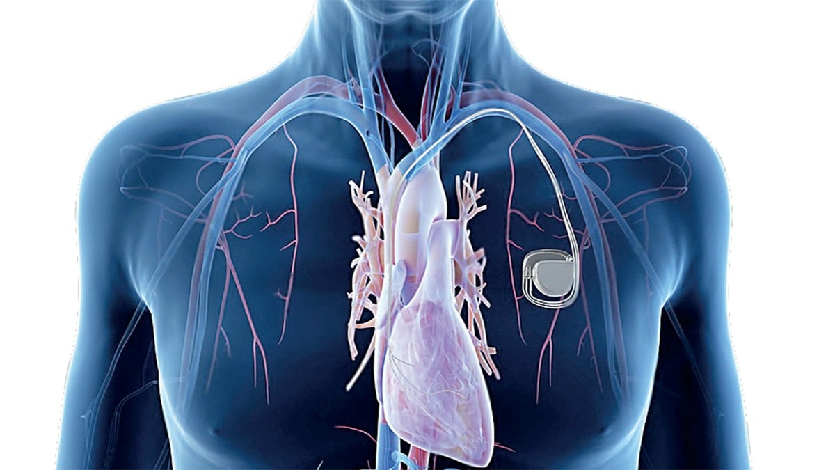 Kalp pili, stent, bypass: Hangisi ne zaman?