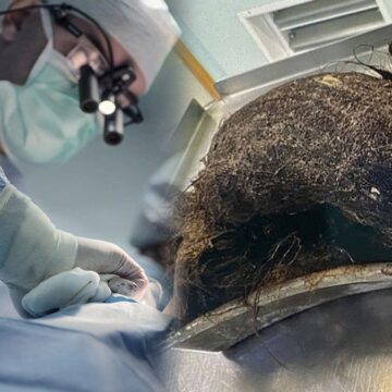 Karın ağrısıyla doktora gitti: Yıllarca içinde durmuş, karpuz kadar!