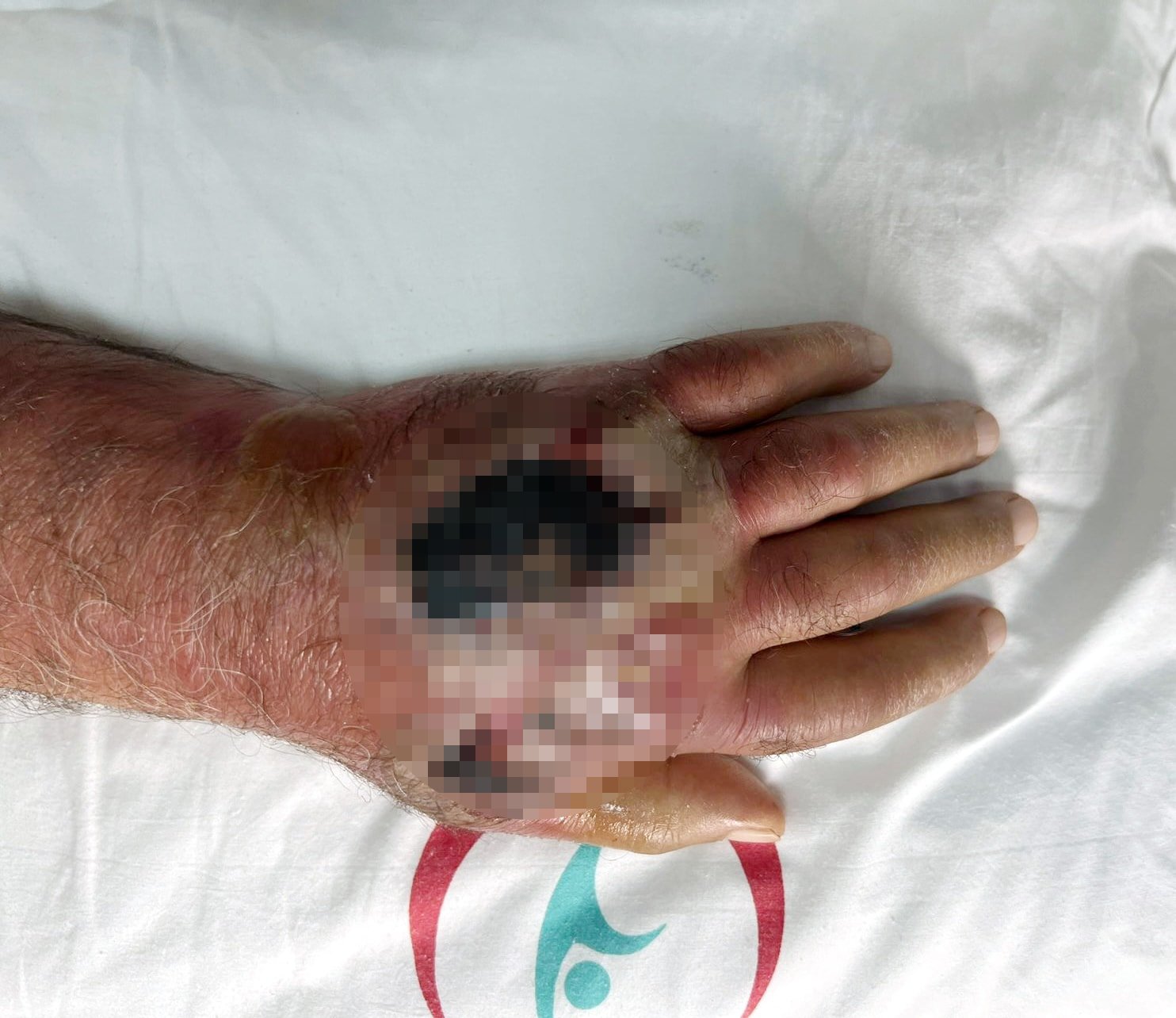 Üsküdar'da tıp tarihine geçecek vaka: Hırsızın ısırığı kolundan ediyordu