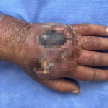 Üsküdar’da tıp tarihine geçecek vaka: Hırsızın ısırığı kolundan ediyordu