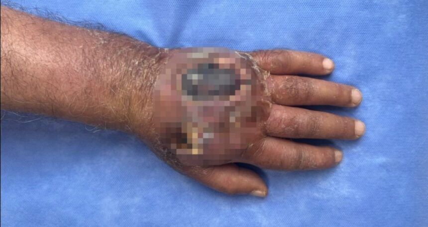 Üsküdar’da tıp tarihine geçecek vaka: Hırsızın ısırığı kolundan ediyordu