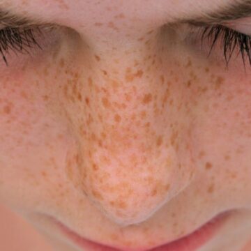 Yaz sonrası cilt lekesi artanlar dikkat