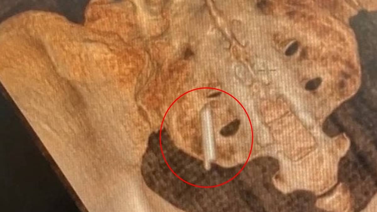 22 yıl boyunca kalçasında unutulan termometre ile yaşadı