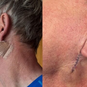 Dünyanın en ünlü şefi kanser oldu: ‘Kremi unutmayın’ uyarısı yaptı